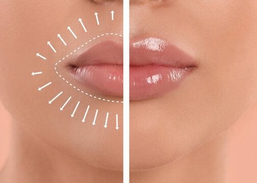 Увеличение объёма губ — процедура